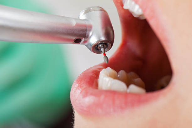 Best Emergency Root Canal Treatment in Medford, MA